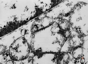 F,12y. | swollen mitochondria - duodenal tumor F,12y. | swollen mitochondria - duodenal tumor